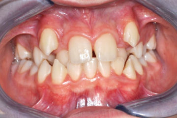 affollamento dentale grave - odontoiatria