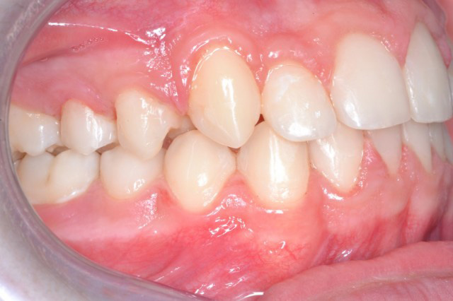 affollamento dentale grave - dott Petrocchi
