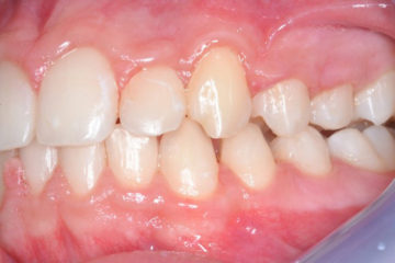 affollamento dentale grave - dott Petrocchi