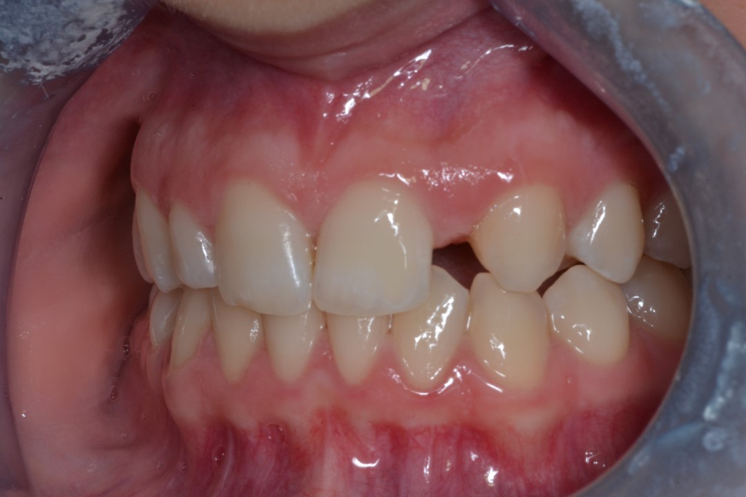 ricostruzione estetica denti
