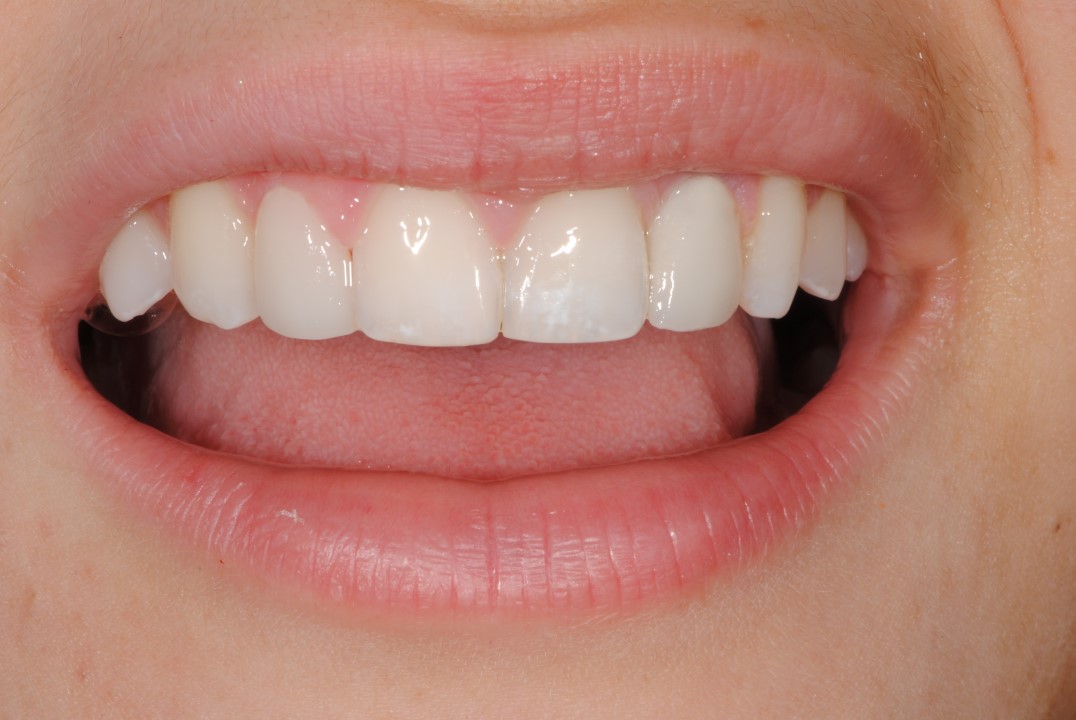 Estetica dentale faccetta su impianto - denti