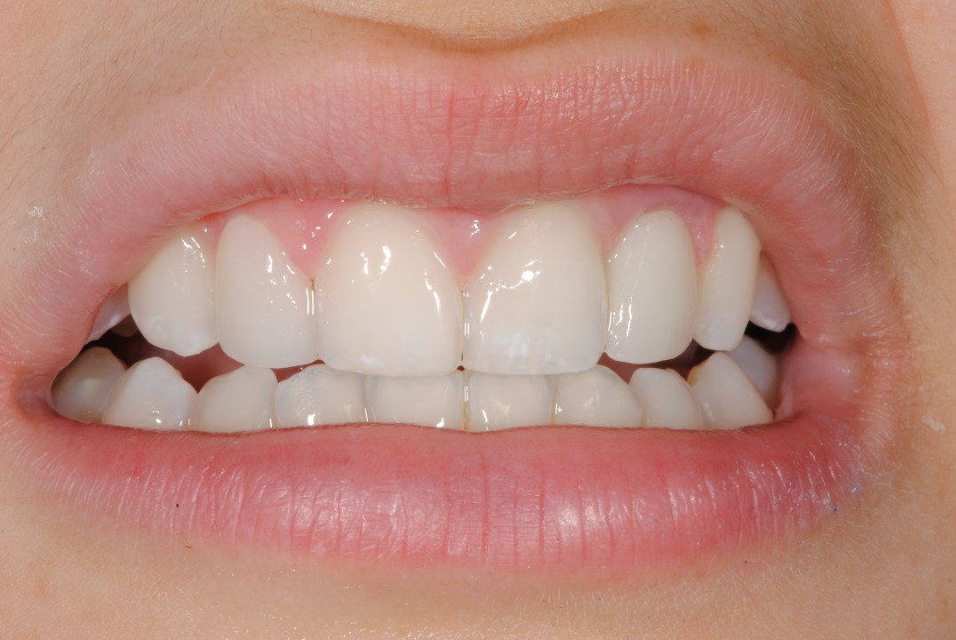 estetica dentale faccetta su impianto - denti